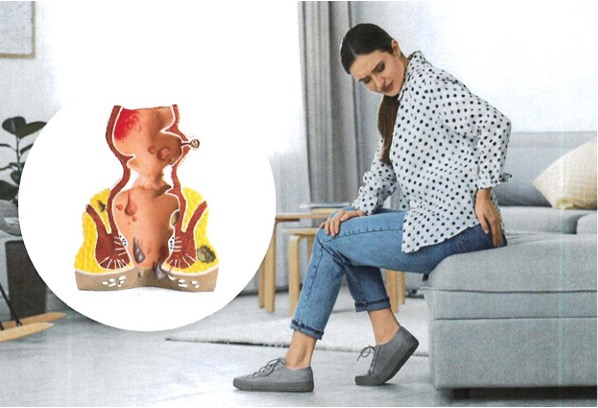 An anatomical model of the rectum with hemorrhoids and a young woman sitting on the sofa suffering from pain at home